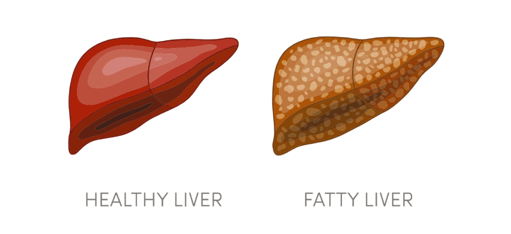 Fatty liver diet, fatty liver treatment